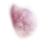 bruise_02